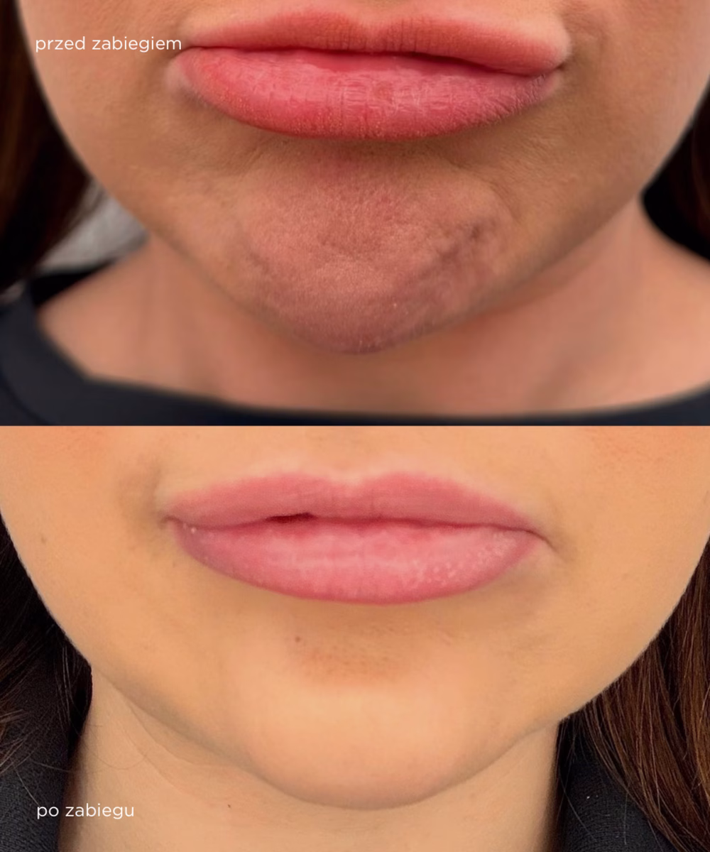 BOTOX