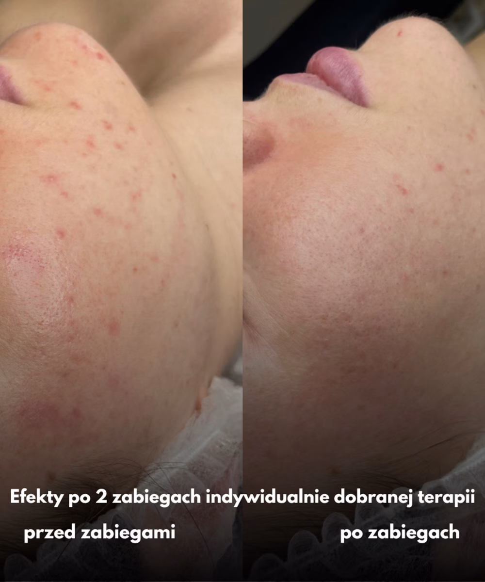Tomaszewska_Clinic_efekty_zabiegow_-08