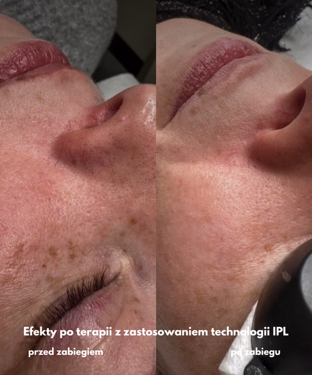 Tomaszewska_Clinic_efekty_zabiegow_-10