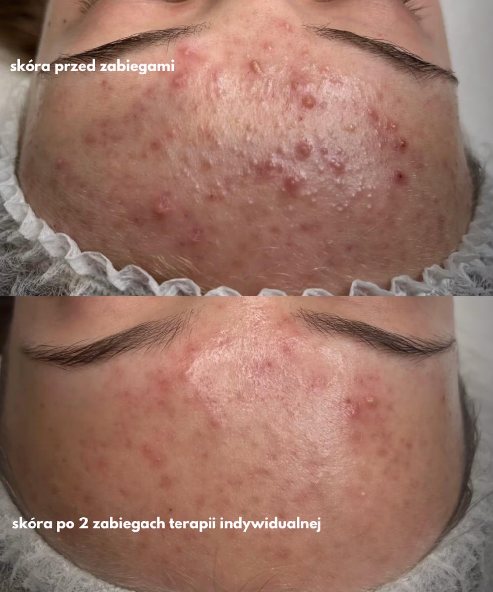 Tomaszewska_Clinic_efekty_zabiegow_-11