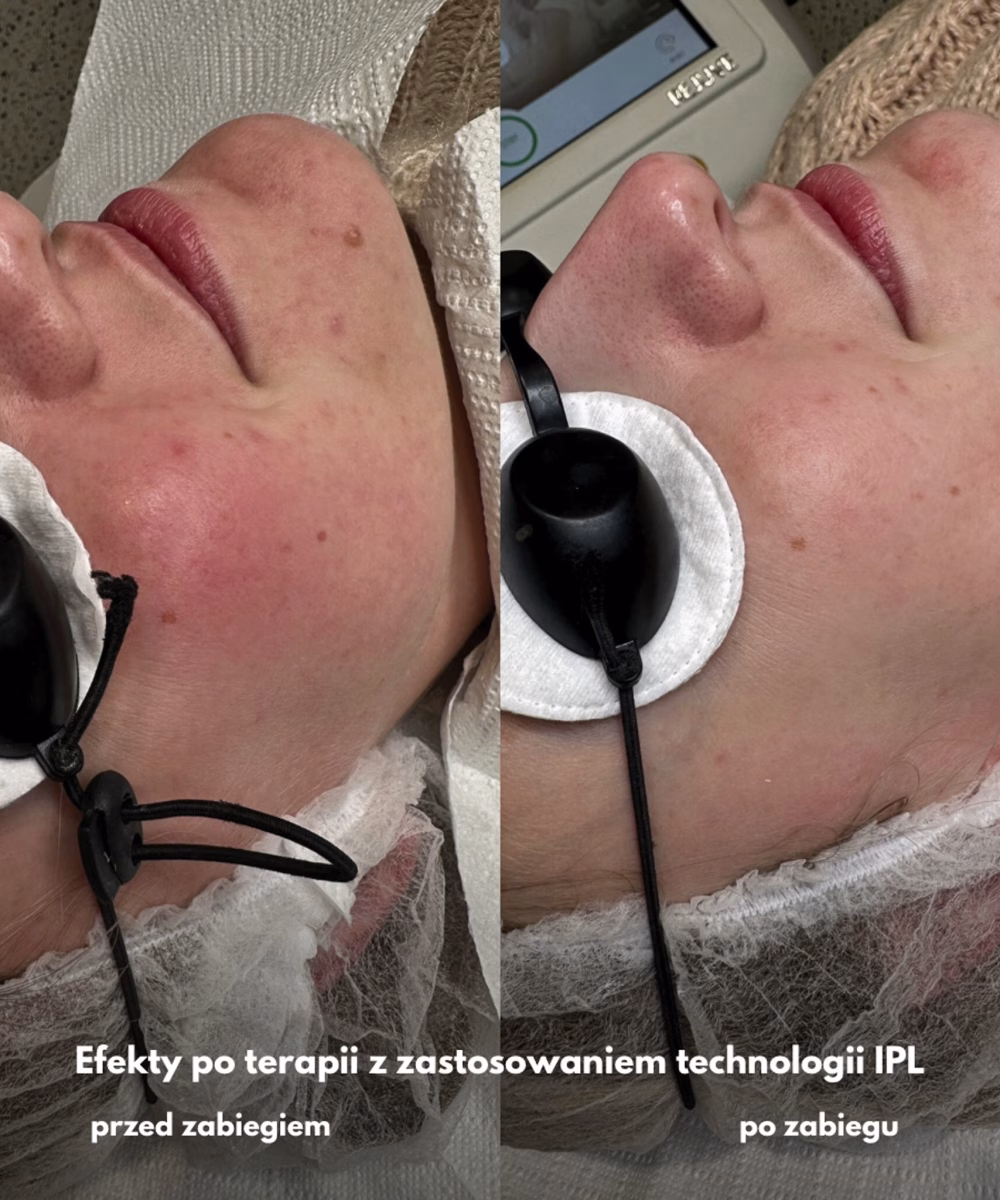 Tomaszewska_Clinic_efekty_zabiegow_-12