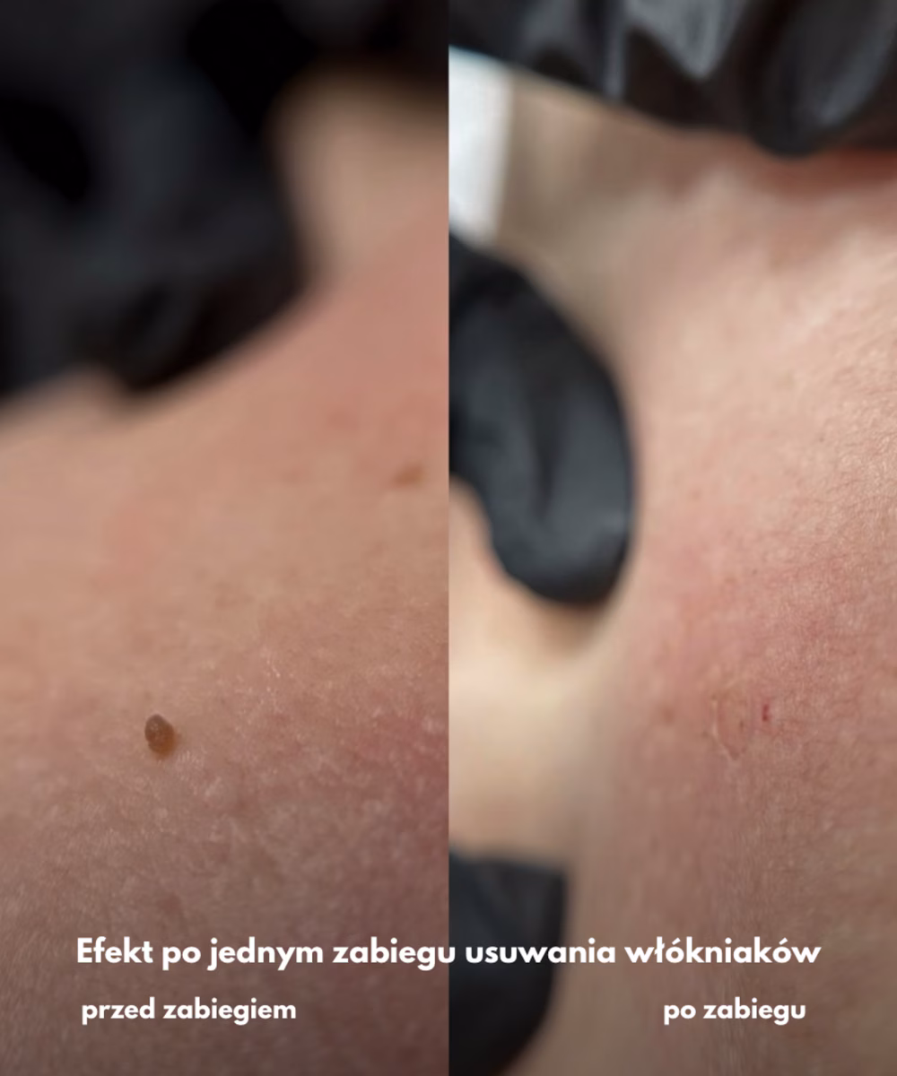 Tomaszewska_Clinic_efekty_zabiegow_-13