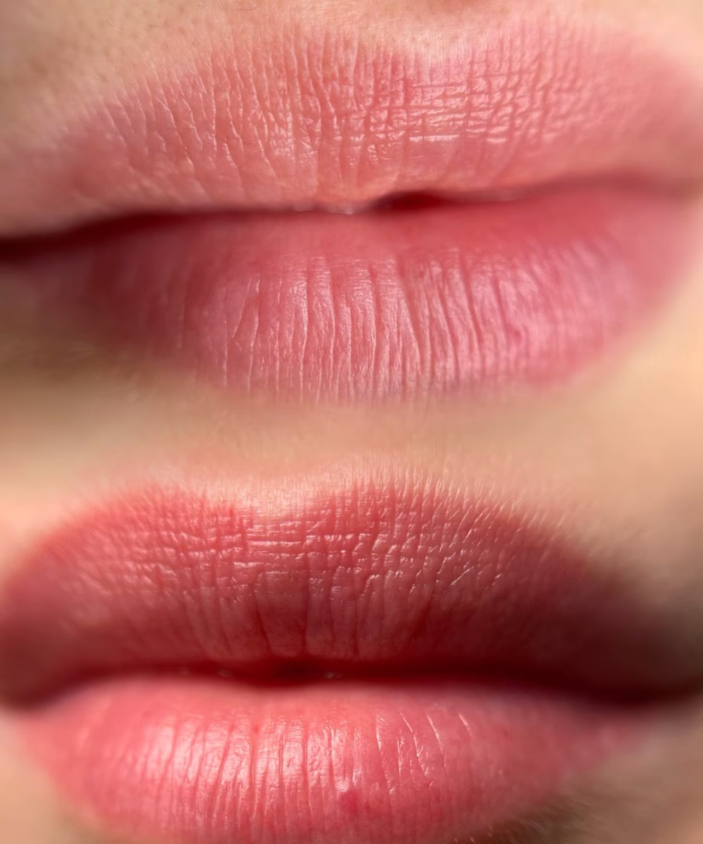 Tomaszewska_Clinic_efekty_zabiegow_-28