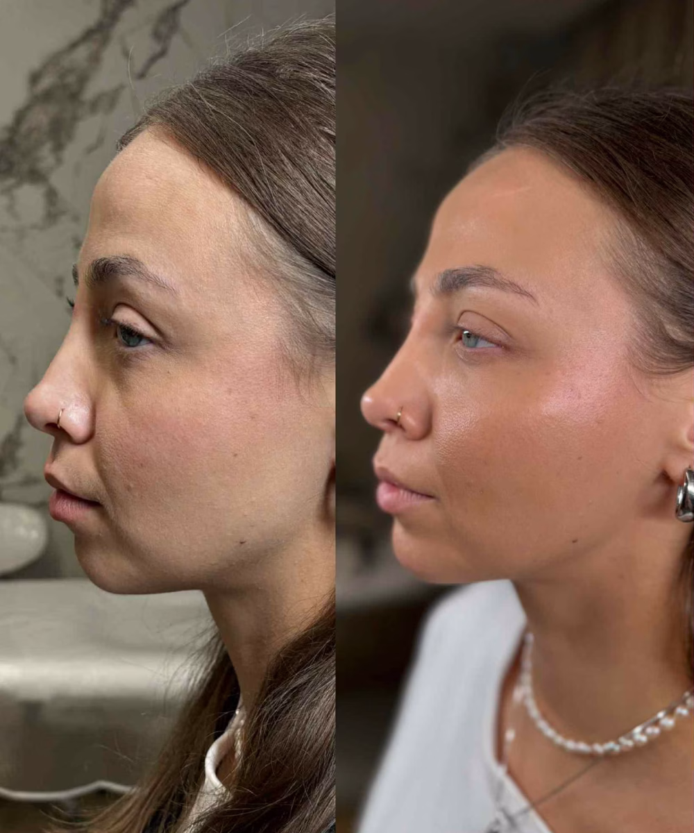 Tomaszewska_Clinic_efekty_zabiegow_-36