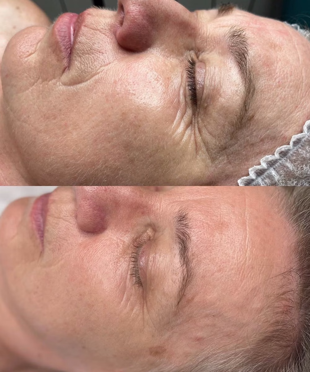 Tomaszewska_Clinic_efekty_zabiegow_-41