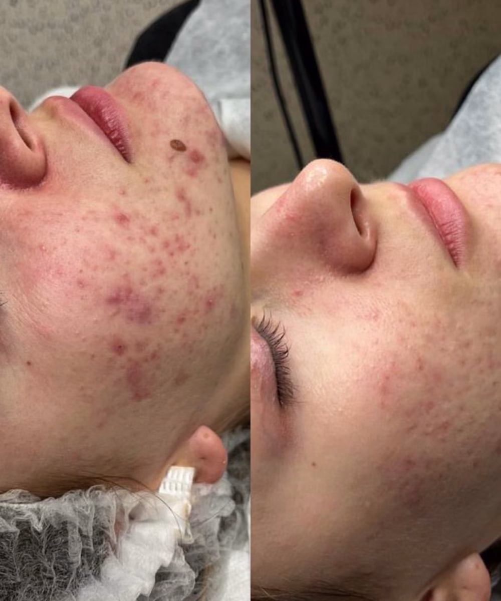 Tomaszewska_Clinic_efekty_zabiegow_-42