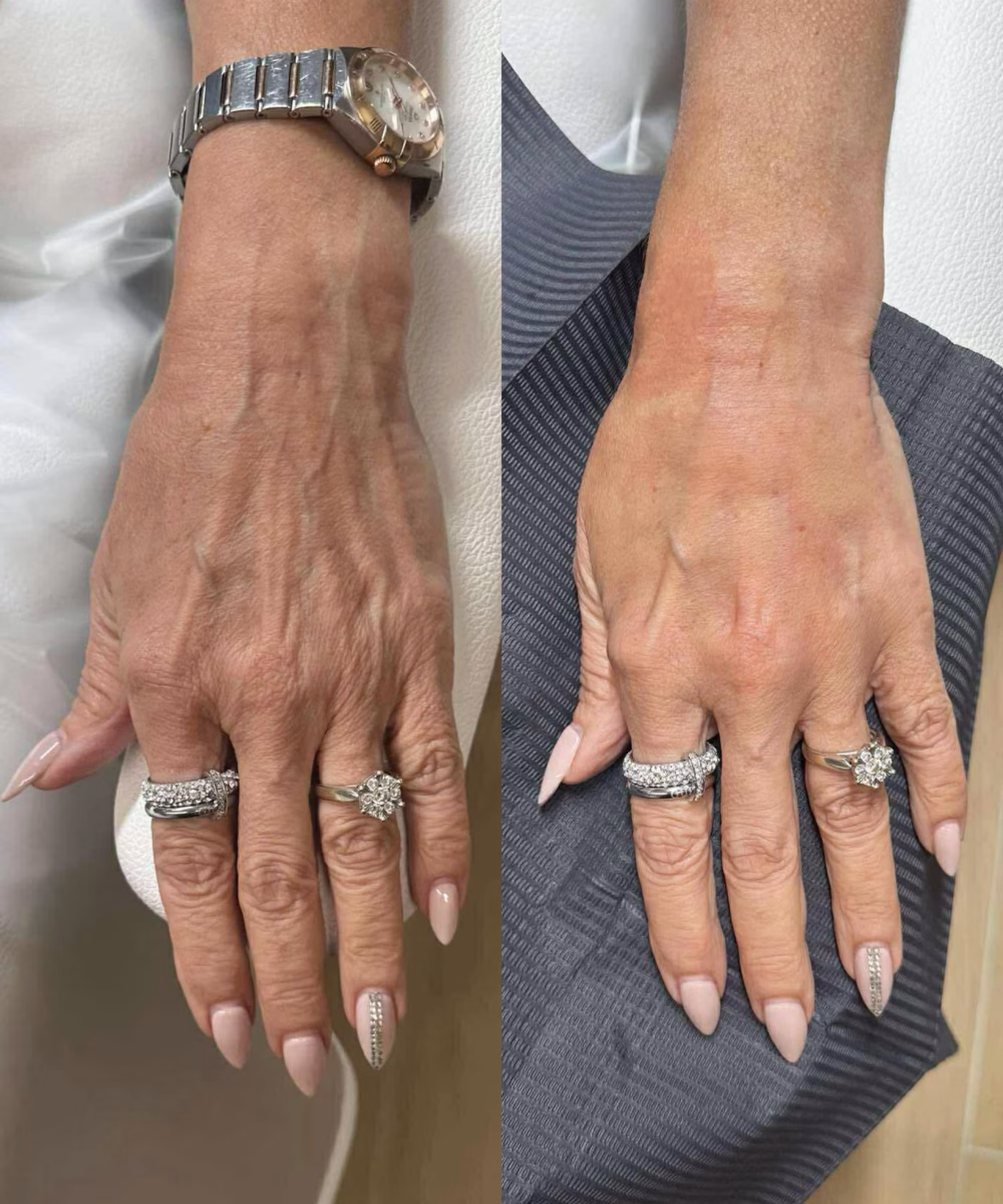 Tomaszewska_Clinic_efekty_zabiegow_-44