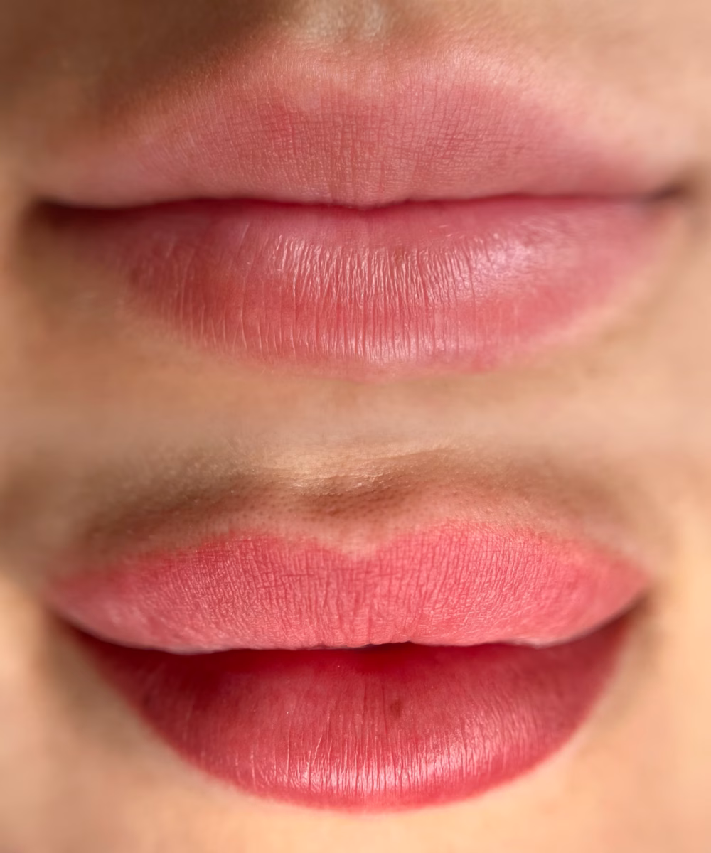 Tomaszewska_Clinic_efekty_zabiegow_-46
